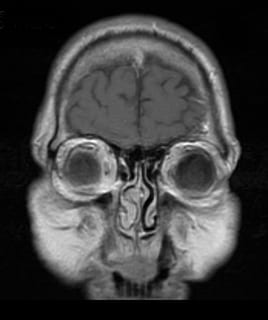 head, brain, scan, mri, demyelinating, medical, doctors, magnetic, resonance, imaging, human body part, human skeleton, bone, body part, black background, human skull, people, close-up, healthcare and medicine, indoors, anatomy, spooky, studio shot, medical exam, x-ray image, human hand, history, the past, human representation, human bone, human face, medical x-ray, 8K